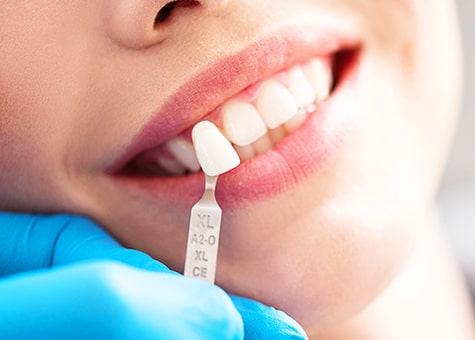 Lentes de Contato Dental